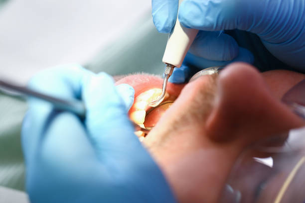 Best Emergency Root Canal Treatment in Hines, OR